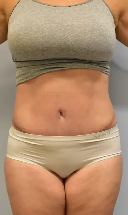 Tummy Tuck patient 11, after