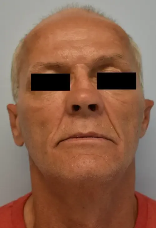 Rhinoplasty patient 11, before