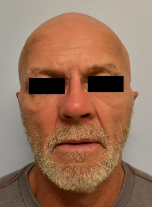 Rhinoplasty patient 11, after