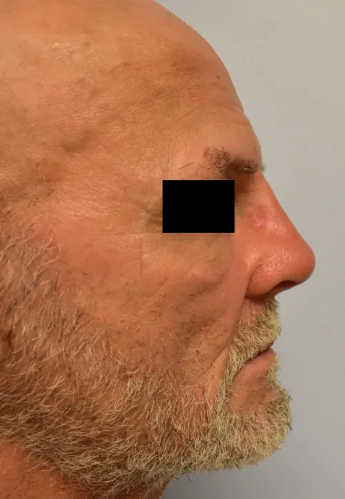 Rhinoplasty patient 12, after