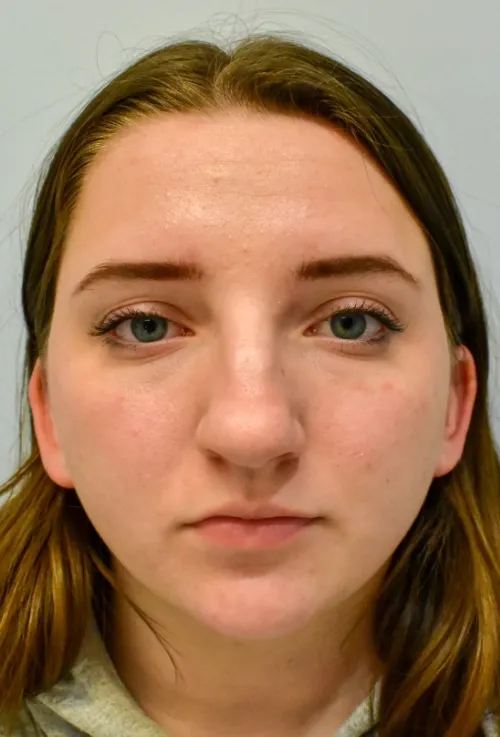 Rhinoplasty patient 9, before