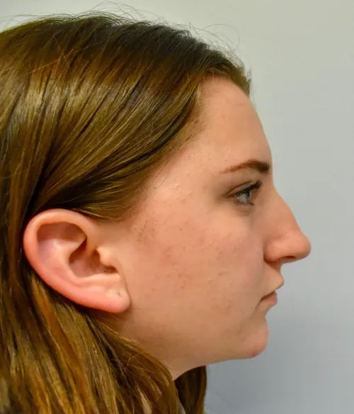Rhinoplasty patient 10, before