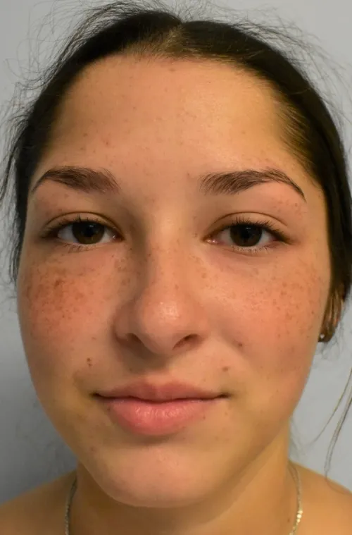Rhinoplasty patient 13, after