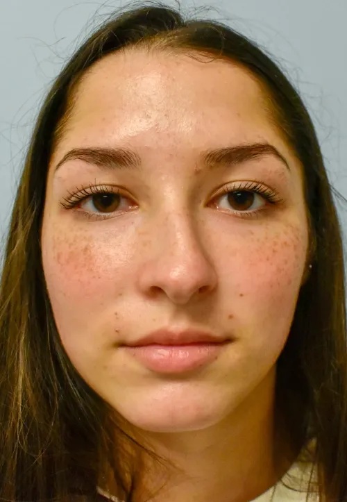 Rhinoplasty patient 13, before