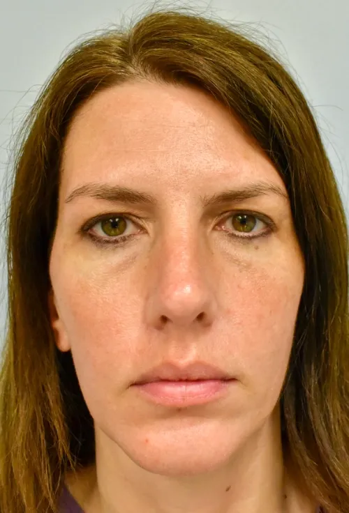 Rhinoplasty patient 7, after