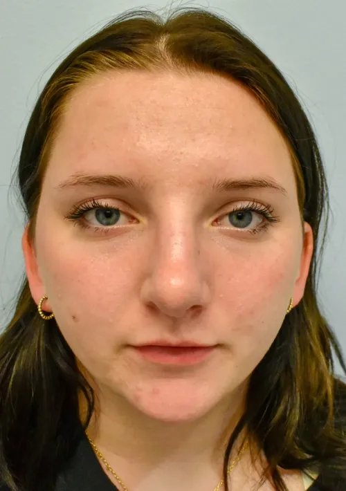 Rhinoplasty patient 9, after
