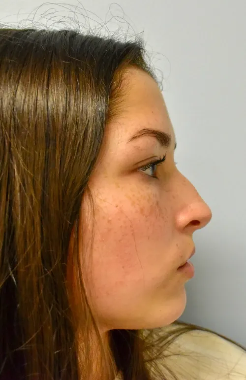 Rhinoplasty patient 14, before