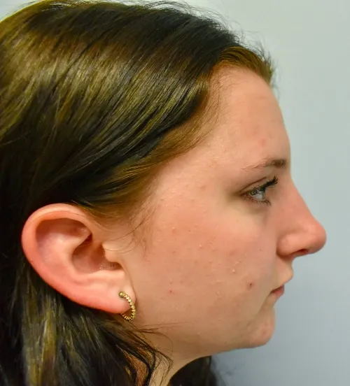 Rhinoplasty patient 10, after