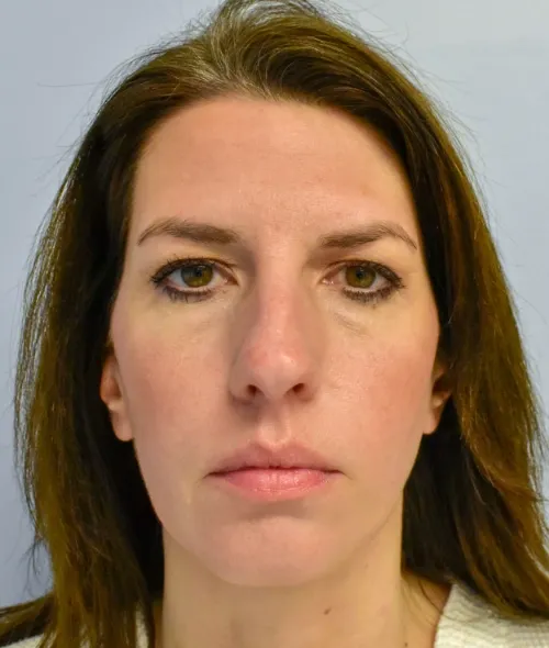 Rhinoplasty patient 7, before