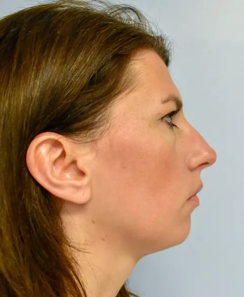 Rhinoplasty patient 8, before
