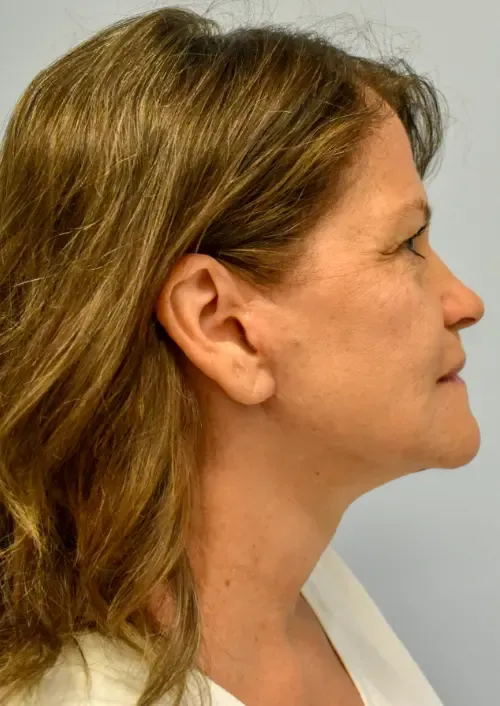 Facelift patient 3, after