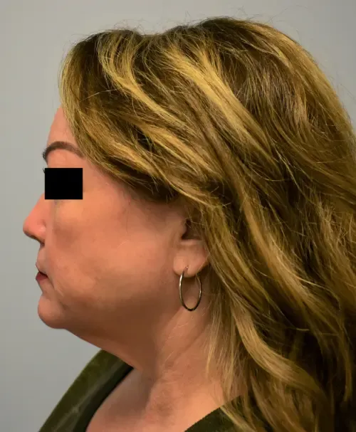 Facelift patient 5, before
