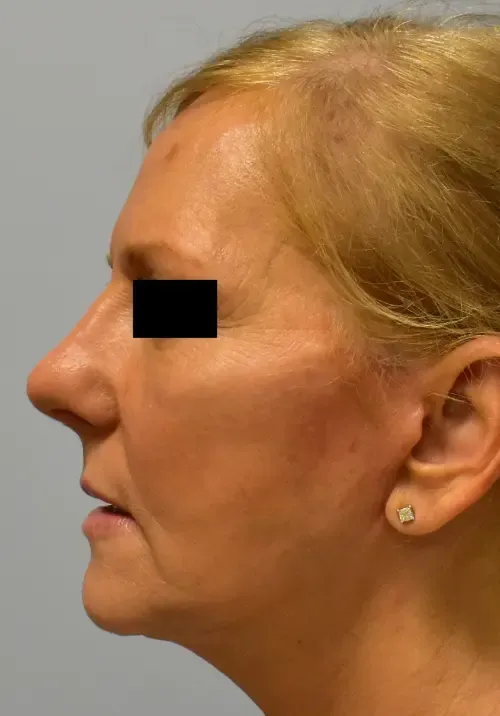 Facelift patient 7, after