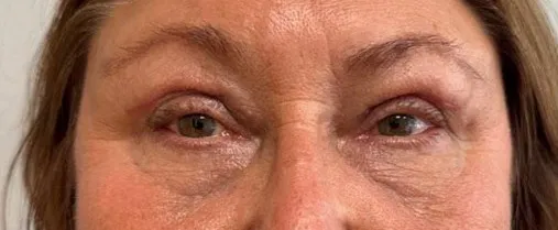 Eyelid Lift (Blepharoplasty) patient 4, after