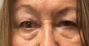 Eyelid Lift (Blepharoplasty) patient 4, before