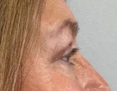 Eyelid Lift (Blepharoplasty) patient 5, after