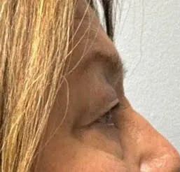 Eyelid Lift (Blepharoplasty) patient 5, before
