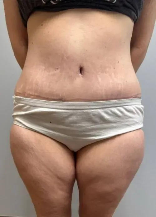 Tummy Tuck patient 13, after