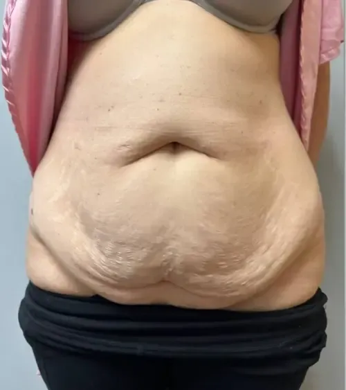 Tummy Tuck patient 13, before