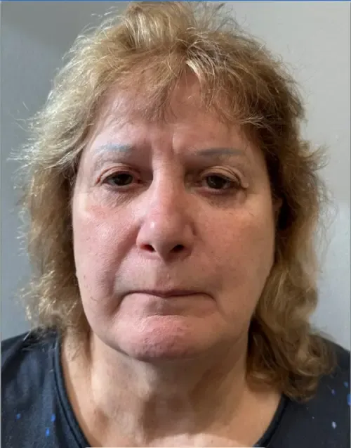 Facelift patient 8, before