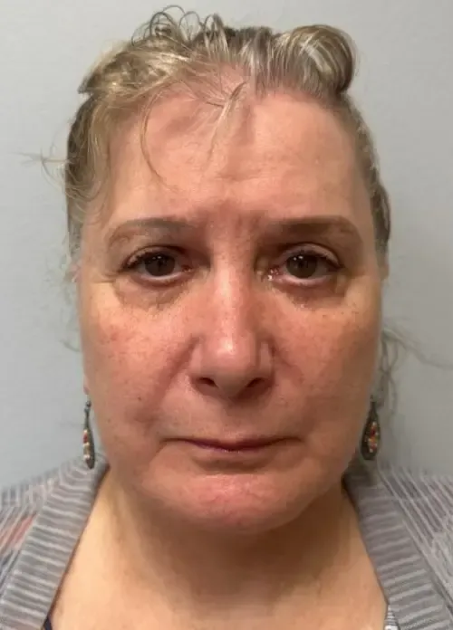 Facelift patient 8, after