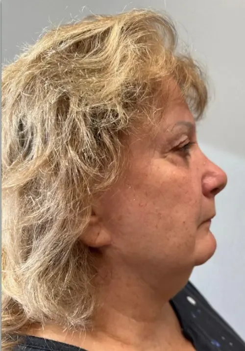 Facelift patient 9, before