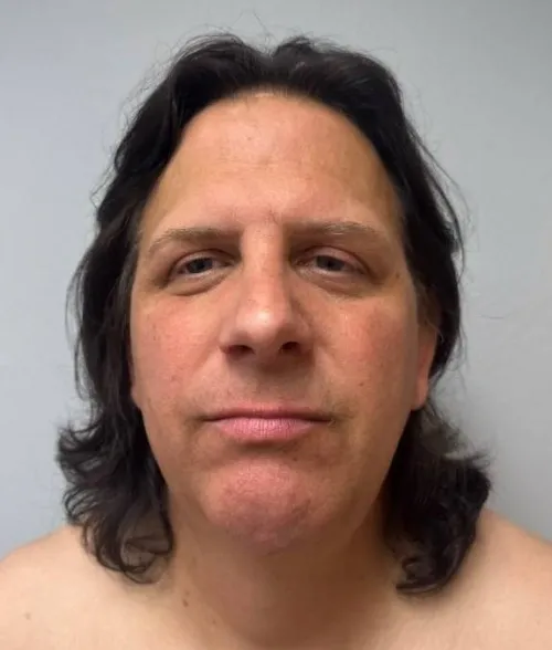 Rhinoplasty patient 15, after