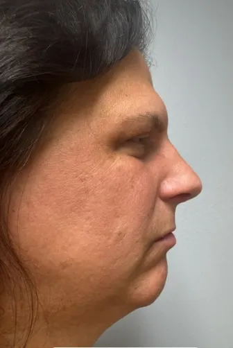 Rhinoplasty patient 16, after
