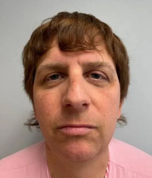 Rhinoplasty patient 15, before