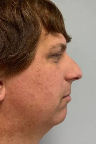 Rhinoplasty patient 16, before