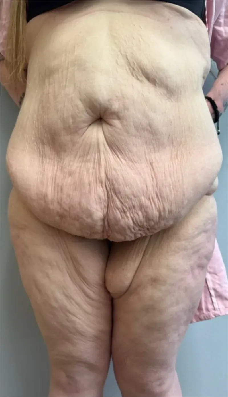 Tummy Tuck patient 14, before