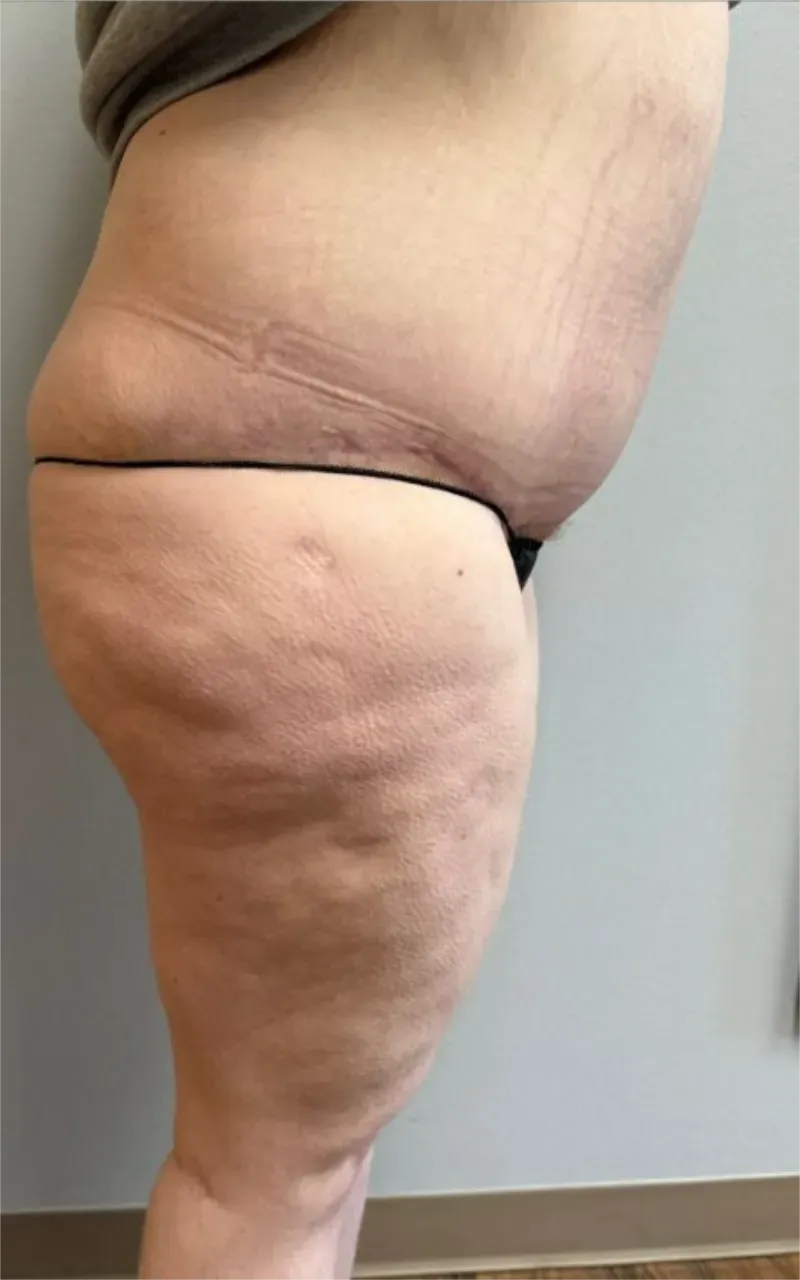 Tummy Tuck patient 15, after