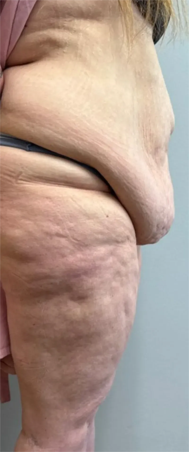 Tummy Tuck patient 15, before