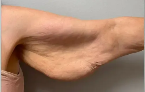 Arm Lift patient 3, before