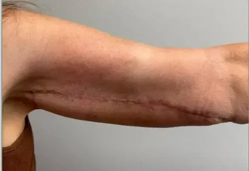 Arm Lift patient 3, after
