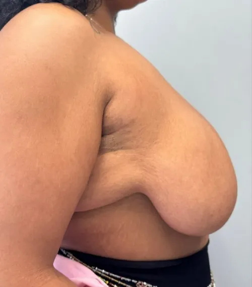 Breast Reduction patient 2, before