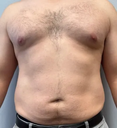 Liposuction patient 1, before