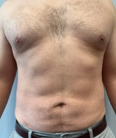 Liposuction patient 1, after