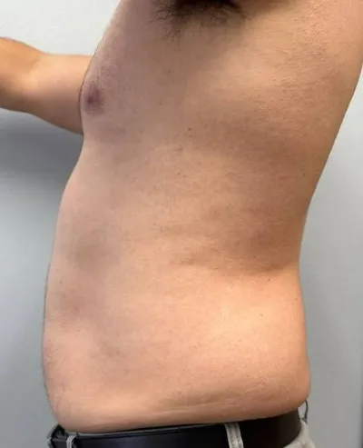 Liposuction patient 2, before