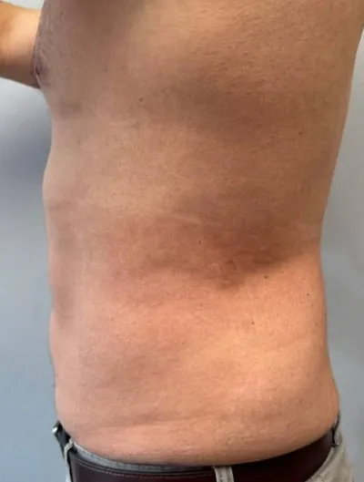 Liposuction patient 2, after