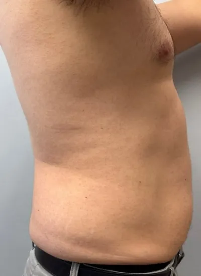 Liposuction patient 3, before