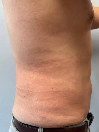 Liposuction patient 3, after