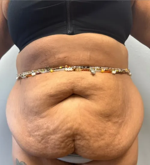 Tummy Tuck patient 16, before