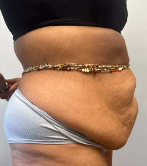 Tummy Tuck patient 17, before
