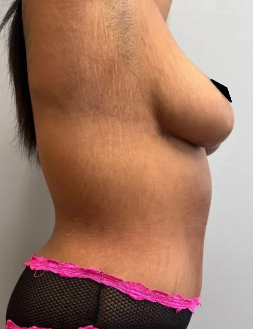 Breast Reduction patient 2, after