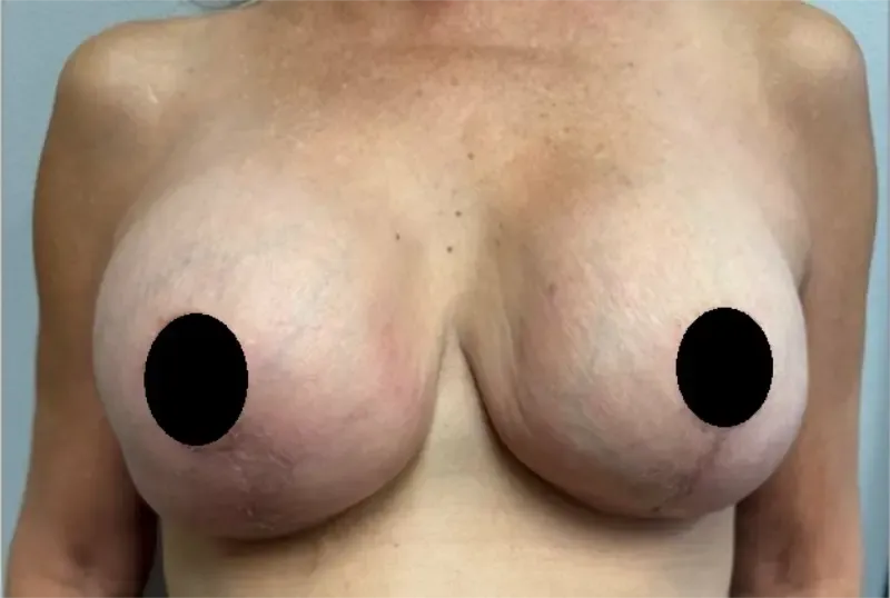 Breast Augmentation patient 9, after