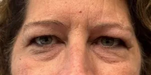 Eyelid Lift (Blepharoplasty) patient 7, before